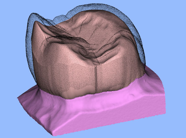 Screenshot einer anatomisch reduzierten Zahnform
